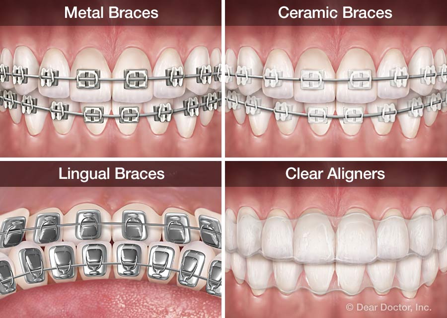 Dentofacial orthopedics/Aligners 3